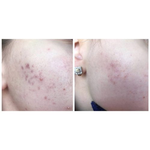 تونر لایه بردار درمانی و آبرسان AHA و BHA کوزارکس COSRX AHA_BHA Clarifying Treatment Toner