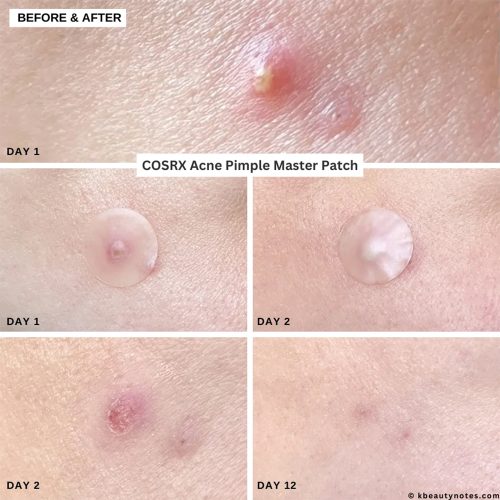 پچ ضد جوش و آکنه کوزارکس 6 پچ ضد جوش و آکنه کوزارکس COSRX Acne Pimple Master Patch