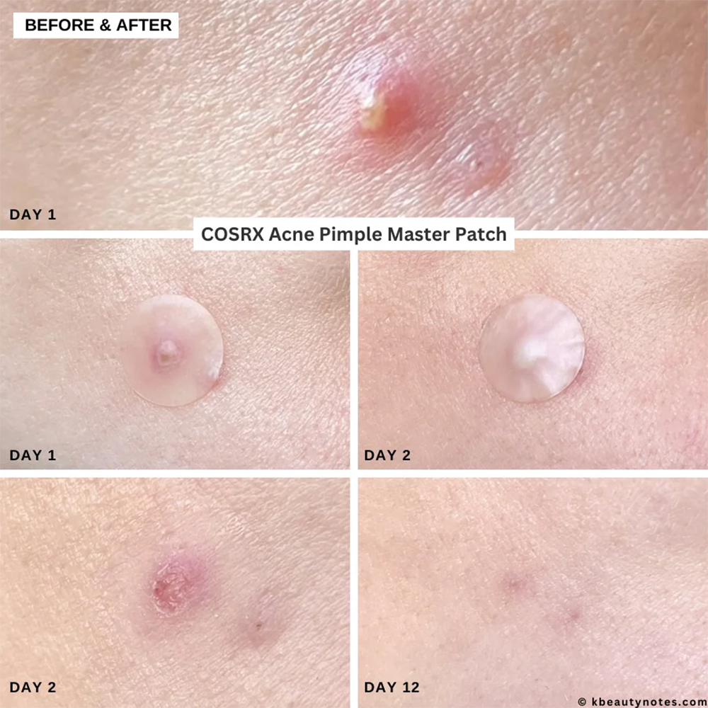 پچ ضد جوش و آکنه کوزارکس 2 پچ ضد جوش و آکنه کوزارکس COSRX Acne Pimple Master Patch