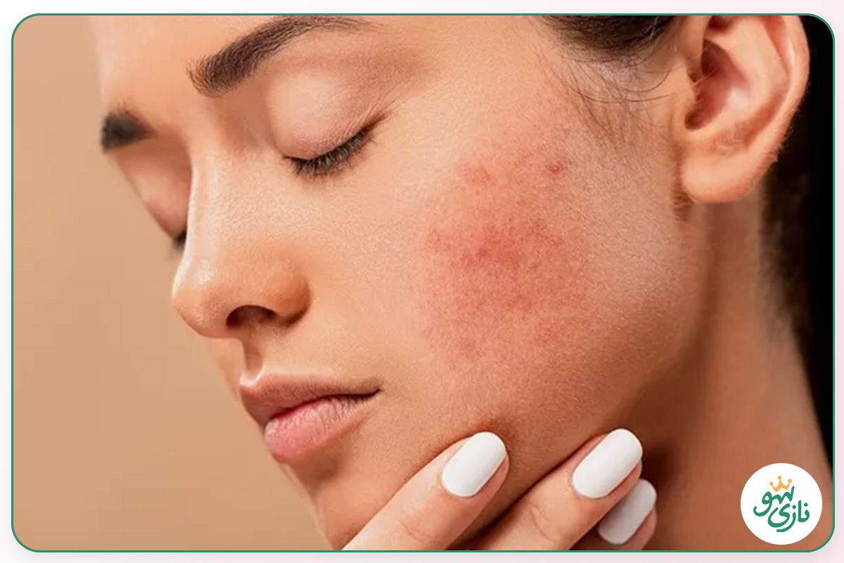 بهترین کرم ترمیم کننده برای جای زخم و جوش