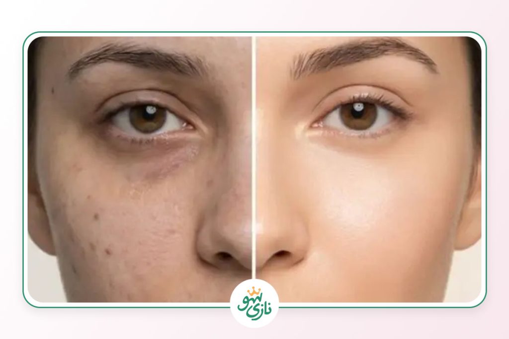 بهترین روتین پوست لک دار و کدر