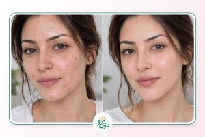 بهترین کرم ترمیم کننده برای از بین بردن جای جوش