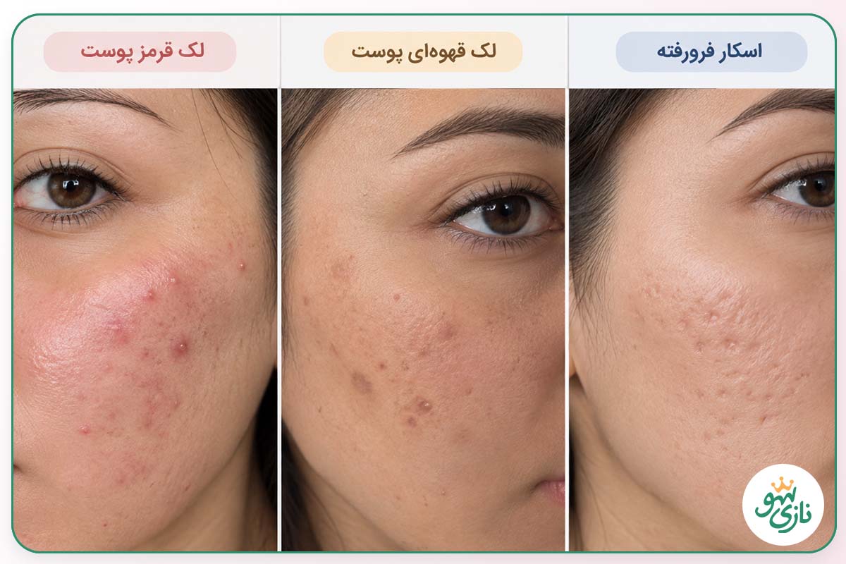 بهترین کرم ترمیم کننده برای از بین بردن جای جوش 2 انواع جای جوش